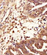 PSMB2 Antibody - Immunohistochemical of paraffin-embedded H. ovarian carcinoma section using PSMB2 Antibody. Antibody was diluted at 1:25 dilution. A undiluted biotinylated goat polyvalent antibody was used as the secondary, followed by DAB staining.
