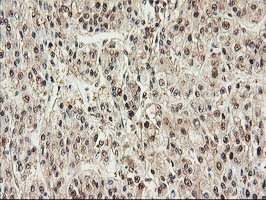 PSMB4 Antibody - IHC of paraffin-embedded Carcinoma of Human liver tissue using anti-PSMB4 mouse monoclonal antibody.