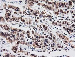 PSMB4 Antibody - IHC of paraffin-embedded Carcinoma of Human lung tissue using anti-PSMB4 mouse monoclonal antibody.