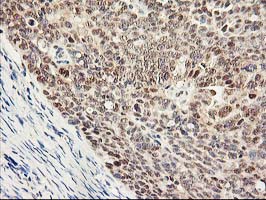 PSMB4 Antibody - IHC of paraffin-embedded Adenocarcinoma of Human ovary tissue using anti-PSMB4 mouse monoclonal antibody.