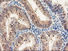 PSMB4 Antibody - IHC of paraffin-embedded Adenocarcinoma of Human endometrium tissue using anti-PSMB4 mouse monoclonal antibody.