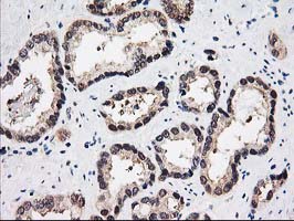 PSMB4 Antibody - IHC of paraffin-embedded Carcinoma of Human prostate tissue using anti-PSMB4 mouse monoclonal antibody.