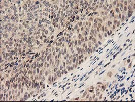 PSMB4 Antibody - IHC of paraffin-embedded Carcinoma of Human bladder tissue using anti-PSMB4 mouse monoclonal antibody.