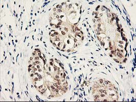 PSMB4 Antibody - IHC of paraffin-embedded Adenocarcinoma of Human breast tissue using anti-PSMB4 mouse monoclonal antibody.