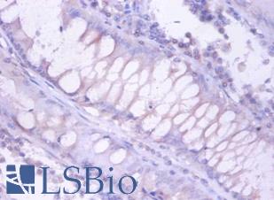PSMB4 Antibody - Immunohistochemistry of paraffin-embedded human colorectal carcinoma using PSMB4 antibody at dilution of 1:100.  This image was taken for the unconjugated form of this product. Other forms have not been tested.