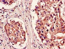 PSMB5 Antibody - Immunohistochemistry of paraffin-embedded human breast cancer using PSMB5 Antibody at dilution of 1:100