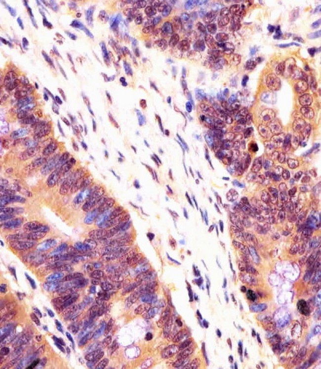 PSMB7 Antibody - Antibody staining PSMB7 in human colorectal carcinoma tissue sections by Immunohistochemistry (IHC-P - paraformaldehyde-fixed, paraffin-embedded sections). Tissue was fixed with formaldehyde and blocked with 3% BSA for 0. 5 hour at room temperature; antigen retrieval was by heat mediation with a citrate buffer (pH 6). Samples were incubated with primary antibody (1:25) for 1 hours at 37°C. A undiluted biotinylated goat polyvalent antibody was used as the secondary antibody.