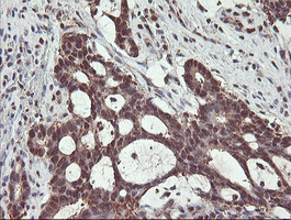 PSMB7 Antibody - IHC of paraffin-embedded Adenocarcinoma of Human colon tissue using anti-PSMB7 mouse monoclonal antibody. (Heat-induced epitope retrieval by 10mM citric buffer, pH6.0, 100C for 10min).