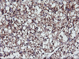PSMB7 Antibody - IHC of paraffin-embedded Carcinoma of Human kidney tissue using anti-PSMB7 mouse monoclonal antibody. (Heat-induced epitope retrieval by 10mM citric buffer, pH6.0, 100C for 10min).