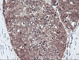 PSMB7 Antibody - IHC of paraffin-embedded Adenocarcinoma of Human ovary tissue using anti-PSMB7 mouse monoclonal antibody. (Heat-induced epitope retrieval by 10mM citric buffer, pH6.0, 100C for 10min).