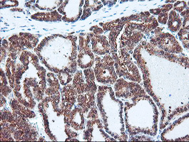 PSMB7 Antibody - IHC of paraffin-embedded Carcinoma of Human thyroid tissue using anti-PSMB7 mouse monoclonal antibody. (Heat-induced epitope retrieval by 10mM citric buffer, pH6.0, 100C for 10min).
