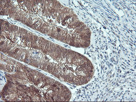 PSMB7 Antibody - IHC of paraffin-embedded Adenocarcinoma of Human endometrium tissue using anti-PSMB7 mouse monoclonal antibody. (Heat-induced epitope retrieval by 10mM citric buffer, pH6.0, 100C for 10min).