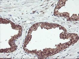 PSMB7 Antibody - IHC of paraffin-embedded Carcinoma of Human prostate tissue using anti-PSMB7 mouse monoclonal antibody. (Heat-induced epitope retrieval by 10mM citric buffer, pH6.0, 100C for 10min).