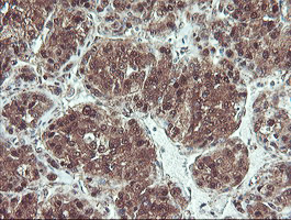 PSMB7 Antibody - IHC of paraffin-embedded Carcinoma of Human liver tissue using anti-PSMB7 mouse monoclonal antibody. (Heat-induced epitope retrieval by 10mM citric buffer, pH6.0, 100C for 10min).