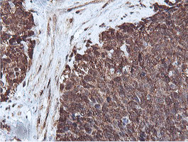 PSMB7 Antibody - IHC of paraffin-embedded Adenocarcinoma of Human breast tissue using anti-PSMB7 mouse monoclonal antibody.