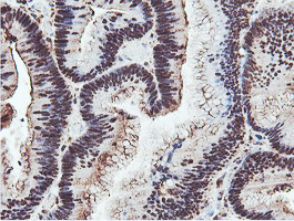 PSMB7 Antibody - IHC of paraffin-embedded Adenocarcinoma of Human colon tissue using anti-PSMB7 mouse monoclonal antibody.
