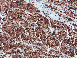 PSMB7 Antibody - IHC of paraffin-embedded Carcinoma of Human liver tissue using anti-PSMB7 mouse monoclonal antibody.