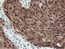 PSMB7 Antibody - IHC of paraffin-embedded Carcinoma of Human bladder tissue using anti-PSMB7 mouse monoclonal antibody.