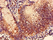 PSMB7 Antibody - Immunohistochemistry of paraffin-embedded human colon cancer using PSMB7 Antibody at dilution of 1:100