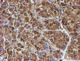 PSMB9 Antibody - IHC of paraffin-embedded Carcinoma of Human liver tissue using anti-PSMB9 mouse monoclonal antibody. (Heat-induced epitope retrieval by 10mM citric buffer, pH6.0, 100C for 10min).
