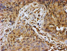 PSMB9 Antibody - IHC of paraffin-embedded Carcinoma of Human lung tissue using anti-PSMB9 mouse monoclonal antibody. (Heat-induced epitope retrieval by 10mM citric buffer, pH6.0, 100C for 10min).