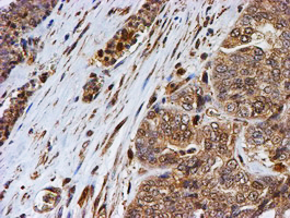 PSMB9 Antibody - IHC of paraffin-embedded Adenocarcinoma of Human ovary tissue using anti-PSMB9 mouse monoclonal antibody. (Heat-induced epitope retrieval by 10mM citric buffer, pH6.0, 100C for 10min).