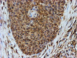 PSMB9 Antibody - IHC of paraffin-embedded Carcinoma of Human bladder tissue using anti-PSMB9 mouse monoclonal antibody. (Heat-induced epitope retrieval by 10mM citric buffer, pH6.0, 100C for 10min).