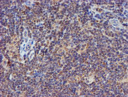 PSMB9 Antibody - IHC of paraffin-embedded Human lymphoma tissue using anti-PSMB9 mouse monoclonal antibody.