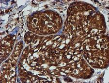 PSMB9 Antibody - IHC of paraffin-embedded Adenocarcinoma of Human breast tissue using anti-PSMB9 mouse monoclonal antibody.
