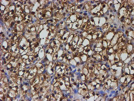 PSMB9 Antibody - IHC of paraffin-embedded Carcinoma of Human kidney tissue using anti-PSMB9 mouse monoclonal antibody. (Heat-induced epitope retrieval by 10mM citric buffer, pH6.0, 100C for 10min).