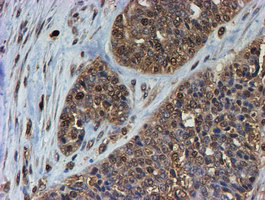 PSMB9 Antibody - IHC of paraffin-embedded Adenocarcinoma of Human ovary tissue using anti-PSMB9 mouse monoclonal antibody. (Heat-induced epitope retrieval by 10mM citric buffer, pH6.0, 100C for 10min).