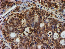 PSMB9 Antibody - IHC of paraffin-embedded Carcinoma of Human pancreas tissue using anti-PSMB9 mouse monoclonal antibody. (Heat-induced epitope retrieval by 10mM citric buffer, pH6.0, 100C for 10min).