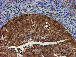 PSMB9 Antibody - IHC of paraffin-embedded Adenocarcinoma of Human endometrium tissue using anti-PSMB9 mouse monoclonal antibody. (Heat-induced epitope retrieval by 10mM citric buffer, pH6.0, 100C for 10min).