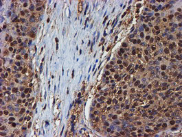 PSMB9 Antibody - IHC of paraffin-embedded Carcinoma of Human bladder tissue using anti-PSMB9 mouse monoclonal antibody. (Heat-induced epitope retrieval by 10mM citric buffer, pH6.0, 100C for 10min).