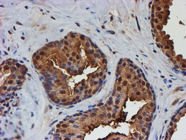 PSMB9 Antibody - IHC of paraffin-embedded Carcinoma of Human prostate tissue using anti-PSMB9 mouse monoclonal antibody. (Heat-induced epitope retrieval by 10mM citric buffer, pH6.0, 100C for 10min).
