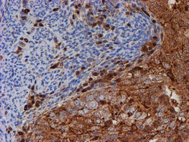 PSMB9 Antibody - IHC of paraffin-embedded Adenocarcinoma of Human endometrium tissue using anti-PSMB9 mouse monoclonal antibody.