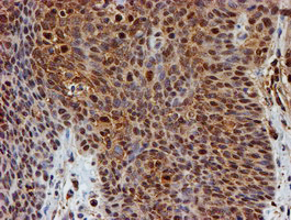PSMB9 Antibody - IHC of paraffin-embedded Carcinoma of Human bladder tissue using anti-PSMB9 mouse monoclonal antibody.