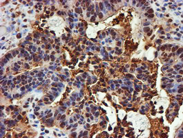 PSMB9 Antibody - IHC of paraffin-embedded Adenocarcinoma of Human colon tissue using anti-PSMB9 mouse monoclonal antibody.