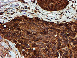 PSMB9 Antibody - IHC of paraffin-embedded Carcinoma of Human lung tissue using anti-PSMB9 mouse monoclonal antibody.