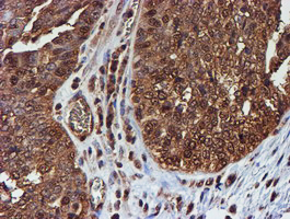 PSMB9 Antibody - IHC of paraffin-embedded Adenocarcinoma of Human ovary tissue using anti-PSMB9 mouse monoclonal antibody.