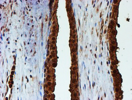 PSMB9 Antibody - IHC of paraffin-embedded Carcinoma of Human prostate tissue using anti-PSMB9 mouse monoclonal antibody.