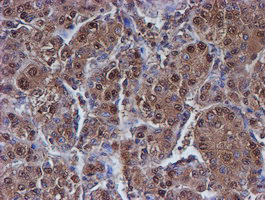 PSMB9 Antibody - IHC of paraffin-embedded Carcinoma of Human liver tissue using anti-PSMB9 mouse monoclonal antibody.