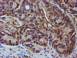 PSMB9 Antibody - IHC of paraffin-embedded Carcinoma of Human pancreas tissue using anti-PSMB9 mouse monoclonal antibody.