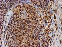 PSMB9 Antibody - IHC of paraffin-embedded Carcinoma of Human bladder tissue using anti-PSMB9 mouse monoclonal antibody.