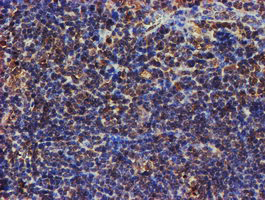 PSMB9 Antibody - IHC of paraffin-embedded Human lymphoma tissue using anti-PSMB9 mouse monoclonal antibody.