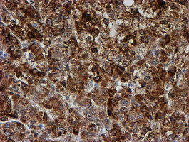 PSMB9 Antibody - IHC of paraffin-embedded Carcinoma of Human liver tissue using anti-PSMB9 mouse monoclonal antibody.