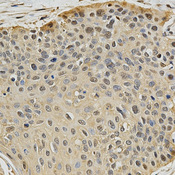 PSMB9 Antibody - Immunohistochemistry of paraffin-embedded human esophageal cancer tissue.