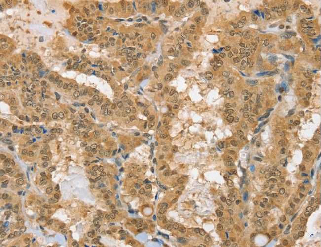 PSMC1 Antibody - Immunohistochemistry of paraffin-embedded Human thyroid cancer using PSMC1 Polyclonal Antibody at dilution of 1:40.