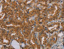 PSMC2 / RPT1 Antibody - Immunohistochemistry of paraffin-embedded Human thyroid cancer using PSMC2 Polyclonal Antibody at dilution of 1:25.