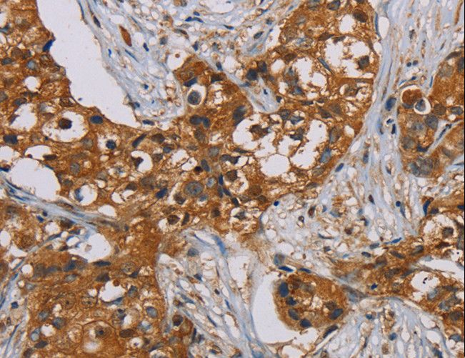 PSMC2 / RPT1 Antibody - Immunohistochemistry of paraffin-embedded Human breast cancer using PSMC2 Polyclonal Antibody at dilution of 1:25.